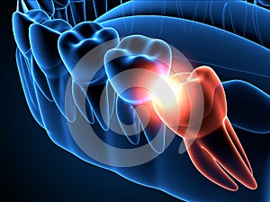 3d render of jaw x-ray with wisdom mesial impaction photo