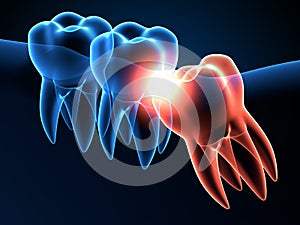 3d render of jaw x-ray with wisdom mesial impaction photo