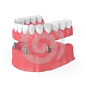 3d render of removable full implant denture photo
