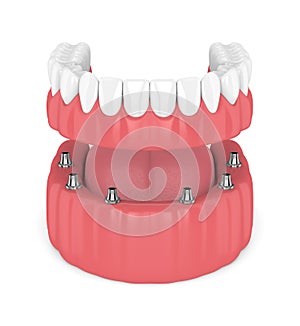 3d render of removable full implant denture photo