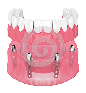 3d render of removable full implant denture photo