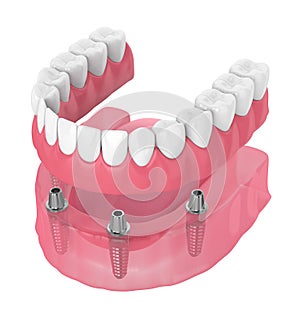 3d render of removable full implant denture photo
