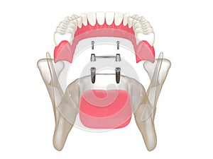 3d render of removable overdenture installation on bar clip attachment supported by implants