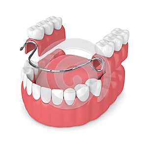 3d render of removable partial denture photo