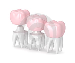 3d render of replacement crown cemented onto reshaped tooth