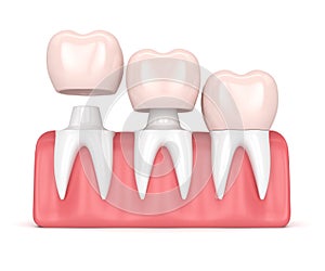 3d render of replacement crowns cemented onto reshaped teeth