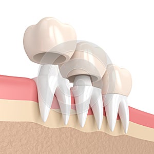 3d render of replacement crowns cemented onto reshaped teeth