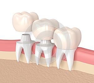 3d render of replacement crowns cemented onto reshaped teeth