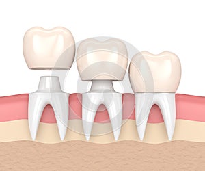 3d render of replacement crowns cemented onto reshaped teeth