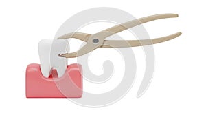 Tooth Extraction with Dental Forceps