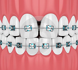 3d render of teeth with convergent diastema and braces photo