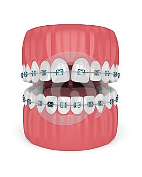 3d render of teeth with convergent diastema and braces photo