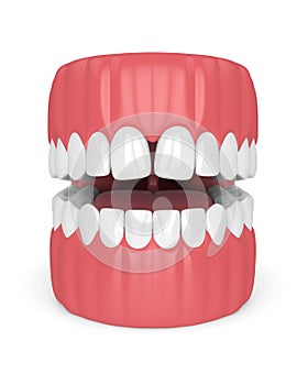 3d render of teeth with convergent diastema photo