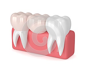 3d render of teeth with dental cantilever bridge photo