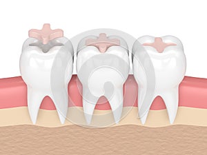 3d render of teeth with dental inlay filling photo
