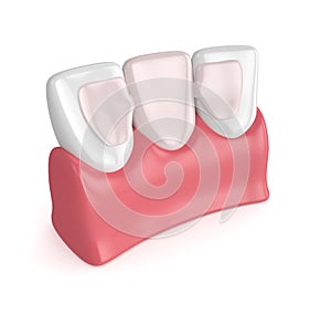 3d render of teeth with dental maryland bridge