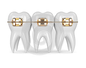 3d render of teeth with golden orthodontic braces photo