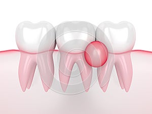 3d render of teeth in gums with cyst