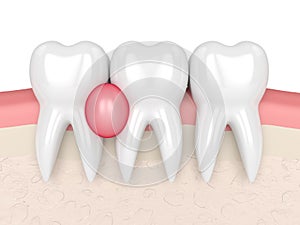 3d render of teeth in gums with cyst