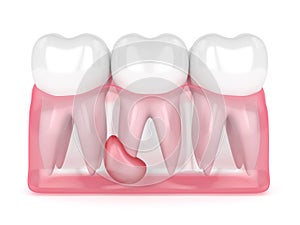 3d render of teeth in gums with cyst