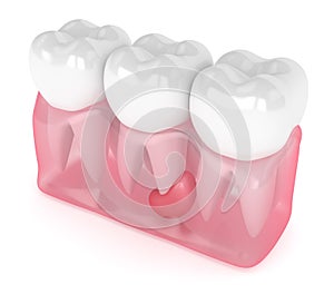 3d render of teeth in gums with cyst