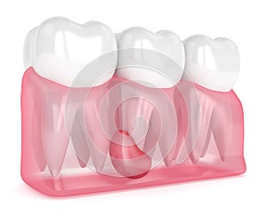 3d render of teeth in gums with cyst