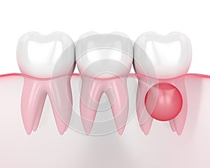 3d render of teeth in gums with cyst