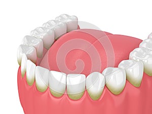 3d render of teeth with plaque and tartar photo