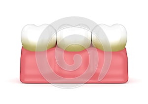 3d render of teeth with plaque and tartar photo