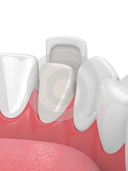 3d render of teeth with veneer