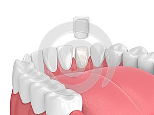 3d render of teeth with veneer