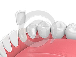 3d render of teeth with veneer