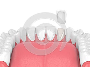 3d render of teeth with veneer