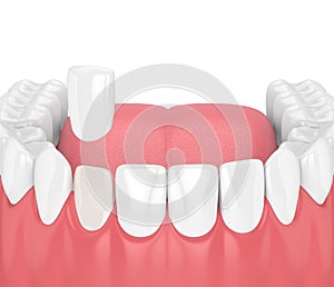 3d render of teeth with veneer