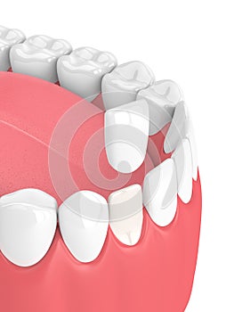 3d render of teeth with veneer