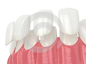 3d render of teeth with veneers