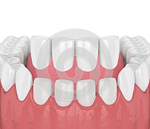 3d render of teeth with veneers