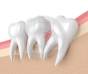 3d render of teeth with wisdom distal impaction photo