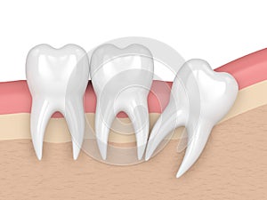3d render of teeth with wisdom distal impaction photo