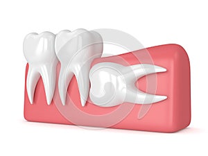 3d render of teeth with wisdom horizontal impaction