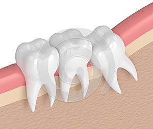 3d render of teeth with wisdom mesial impaction photo