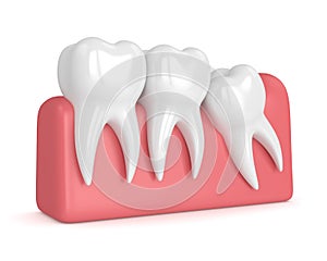 3d render of teeth with wisdom mesial impaction photo