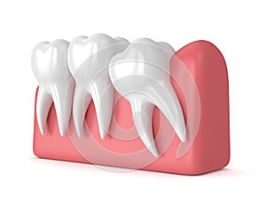 3d render of teeth with wisdom mesial impaction