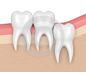 3d render of teeth with wisdom vertical impaction