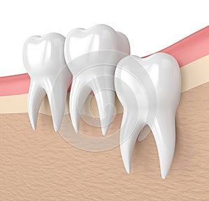 3d render of teeth with wisdom vertical impaction