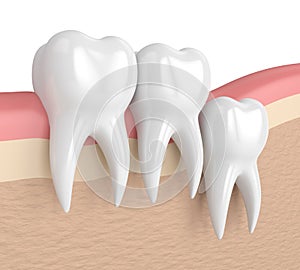 3d render of teeth with wisdom vertical impaction