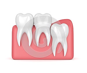 3d render of teeth with wisdom vertical impaction