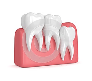3d render of teeth with wisdom vertical impaction