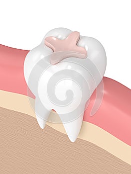 3d render of tooth with dental inlay filling photo