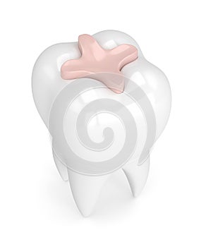 3d render of tooth with dental inlay filling photo